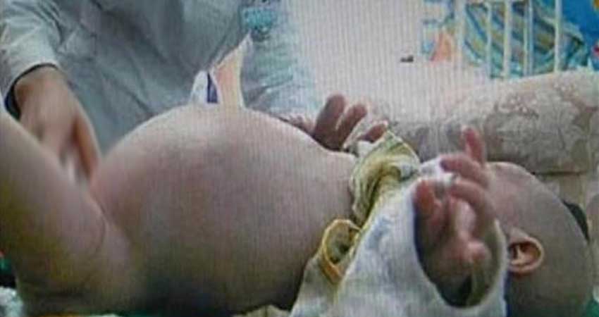يحدث في تونس.. مولود يحمل شقيقه التوأم في بطنه